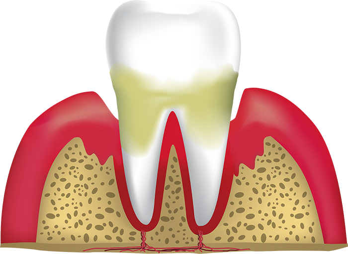 periodontitis Lafayette IN